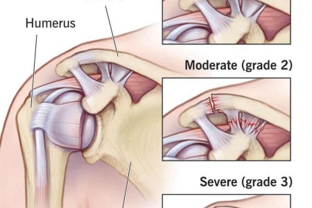 Shoulder Sprains