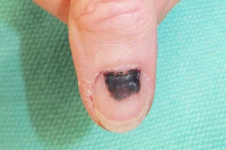 Subungual Melanoma