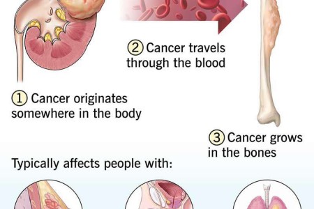 Bone Metastasis