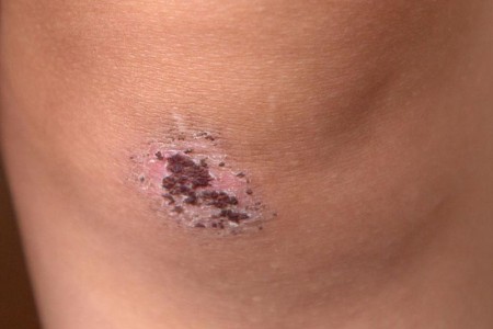 Scab