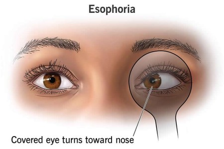 Esophoria