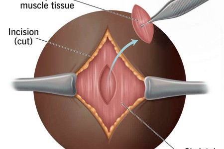 Muscle Biopsy