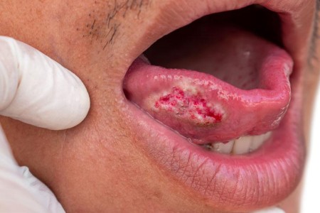 Tongue Cancer