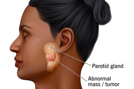 Parotid Gland Tumor
