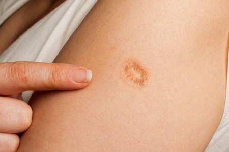 Smallpox Vaccine Scar