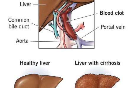 Portal Vein Thrombosis