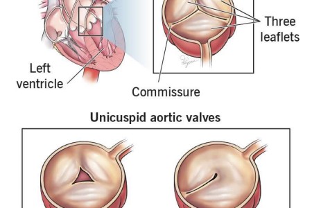 Unicuspid Aortic Valve