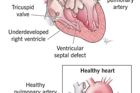 Hypoplastic Right Heart Syndrome