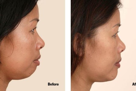 Genioplasty (Chin Augmentation)