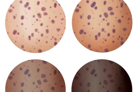 Blueberry Muffin Rash