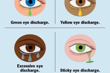 Eye Discharge