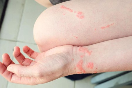 Should You Pee on a Jellyfish Sting?