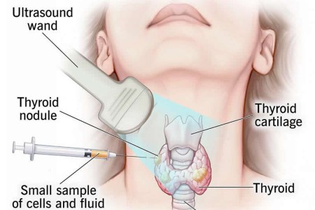 Thyroid Biopsy