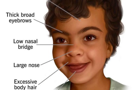 Sanfilippo Syndrome