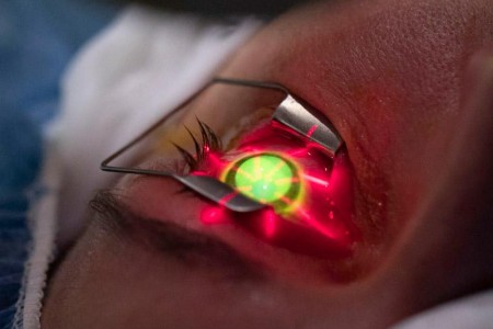 Corneal Cross-Linking