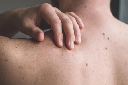 What To Expect During a Full-Body Skin Cancer Screening