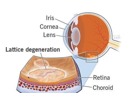 Lattice Degeneration