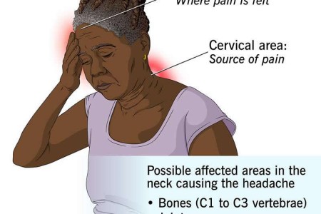 Cervicogenic Headache