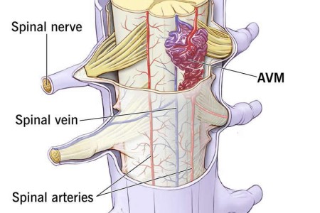 Spinal Arteriovenous Malformation (AVM)