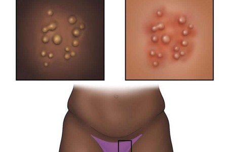 Genital Herpes
