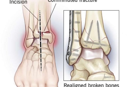 Open Reduction and Internal Fixation (ORIF)