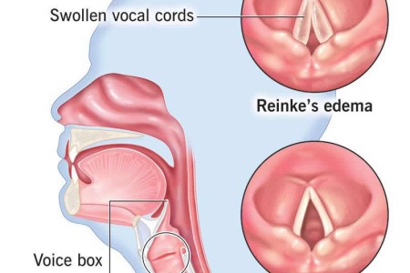 Reinke's Edema
