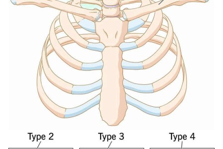 Cervical Rib