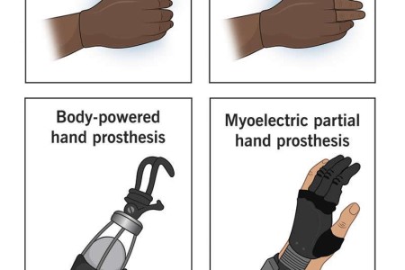 Prosthetic Hand