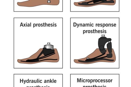 Prosthetic Foot