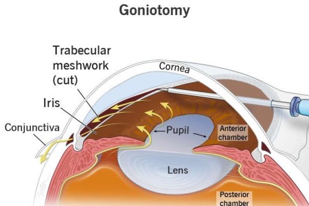 Goniotomy