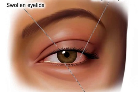 Allergic Conjunctivitis