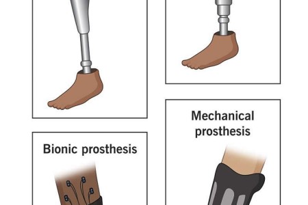 Prosthetic Leg