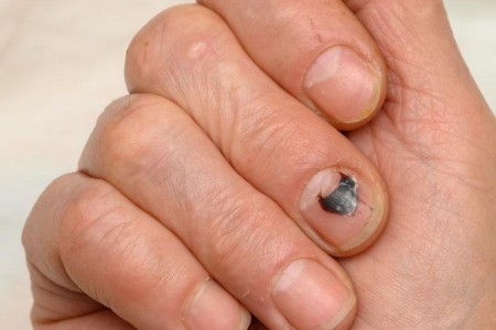 Subungual Hematoma