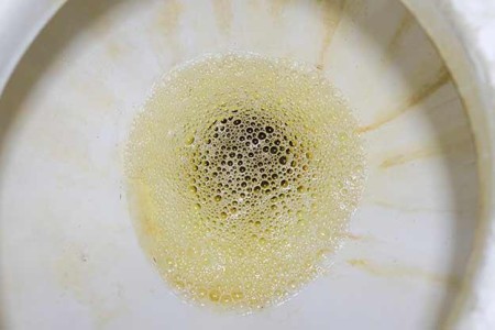 Foamy Urine