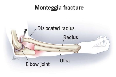 Monteggia Fracture