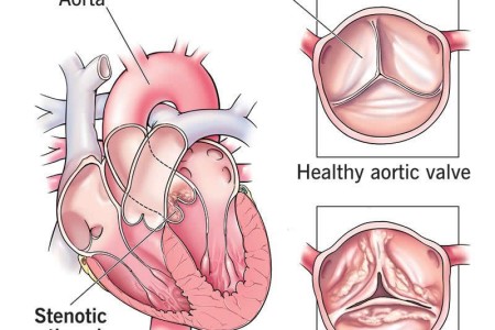 Aortic Stenosis