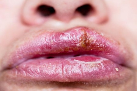 Oral Herpes
