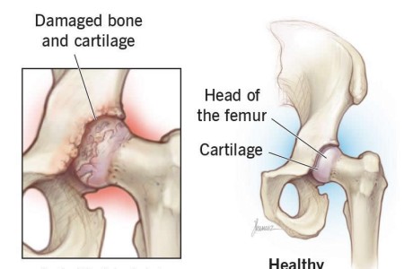 Hip Arthritis