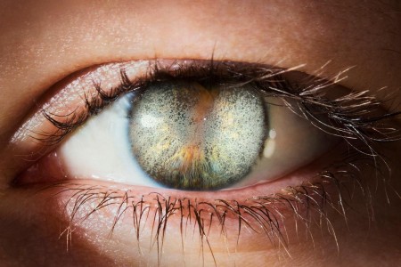 Corneal Dystrophy