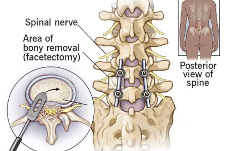 TLIF (Transforaminal Lumbar Interbody Fusion)