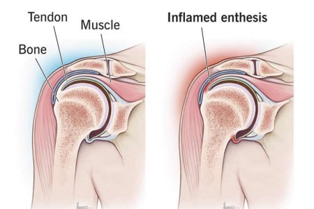 Enthesopathy and Enthesitis