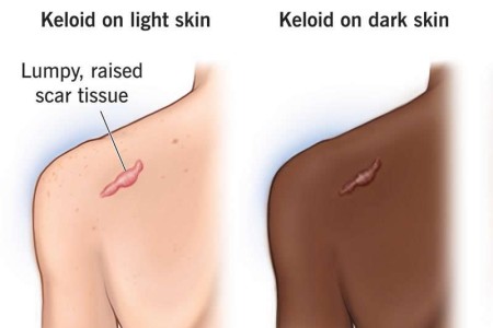 Keloid Scar