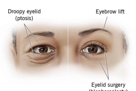Oculoplastics (Oculoplastic Surgery)