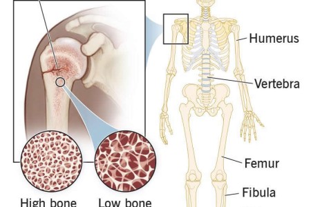 Pathologic Fracture