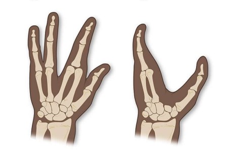 Ectrodactyly