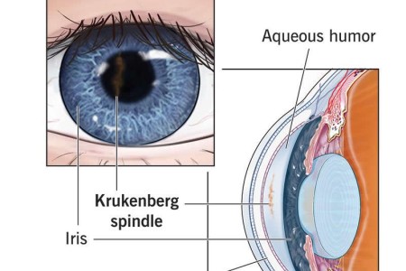 Pigment Dispersion Syndrome & Pigmentary Glaucoma