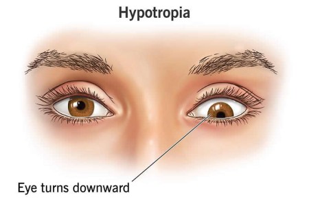 Hypotropia