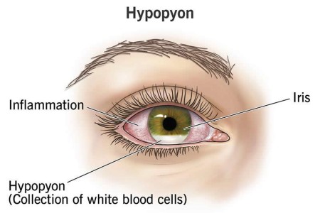 Hypopyon