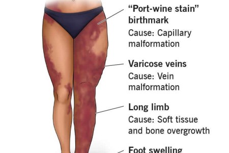 Klippel-Trenaunay Syndrome