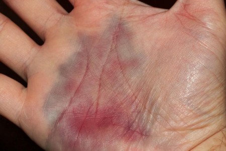Hematoma